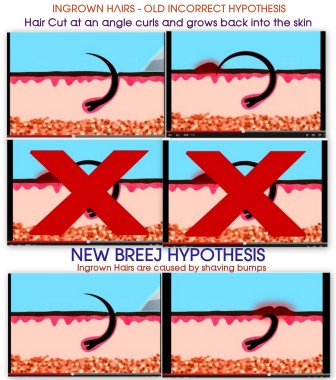 Ingrown Hairs - Old Hypothesis and new BREEJ Hypothesis